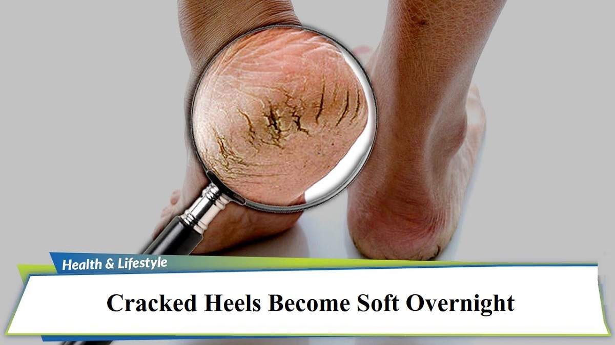 10 Simple Home Remedies For Cracked Heels - YouTube