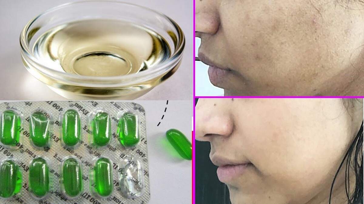 Vitamin E Capsules Very Beneficial in Removing Blemishes & Brightening
