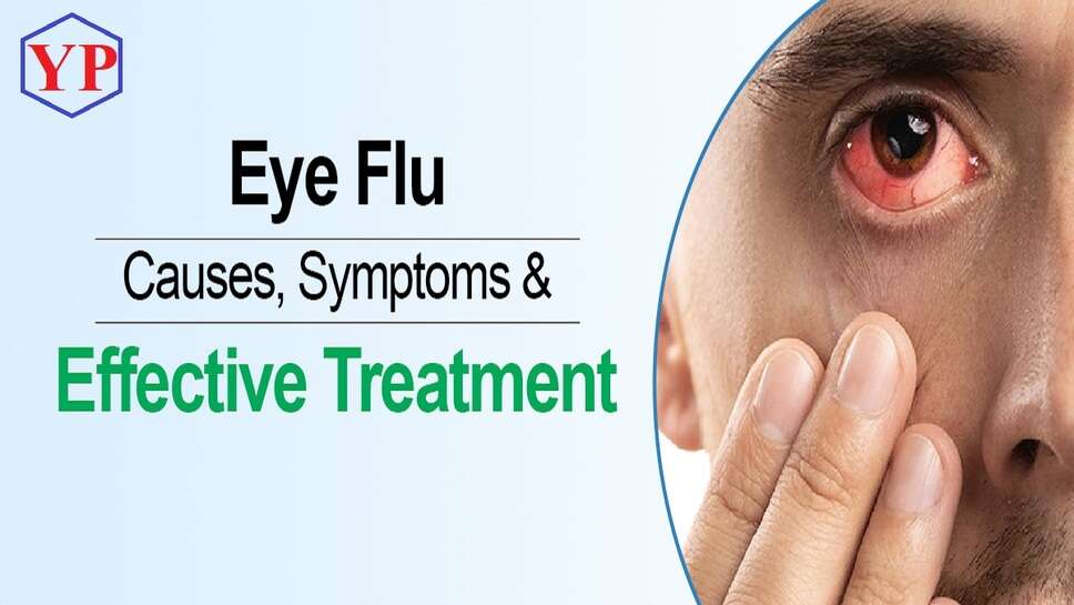 Eye Flu Treatment Causes, Symptoms & Effective Treatment of Eye Flu